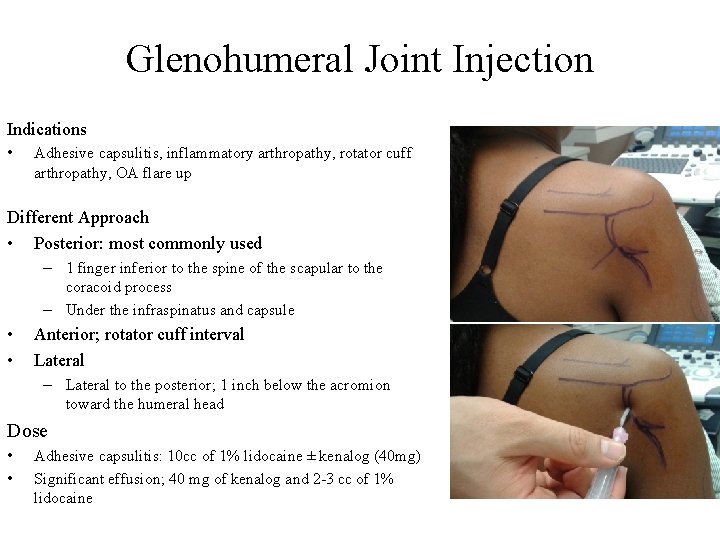 Glenohumeral Joint Injection Indications • Adhesive capsulitis, inflammatory arthropathy, rotator cuff arthropathy, OA flare