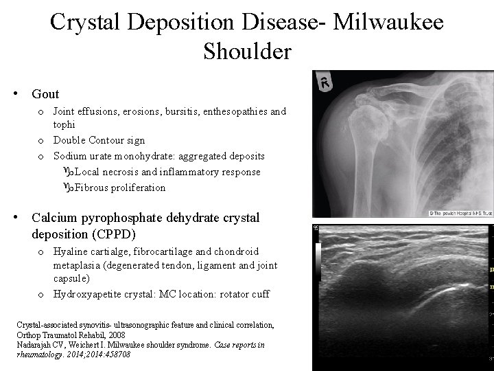Crystal Deposition Disease- Milwaukee Shoulder • Gout o Joint effusions, erosions, bursitis, enthesopathies and