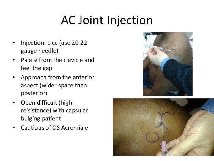 AC Joint Injection • Injection: 1 cc (use 20 -22 gauge needle) • Palate