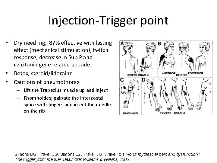 Injection-Trigger point • Dry needling; 87% effective with lasting effect (mechanical stimulation), twitch response,
