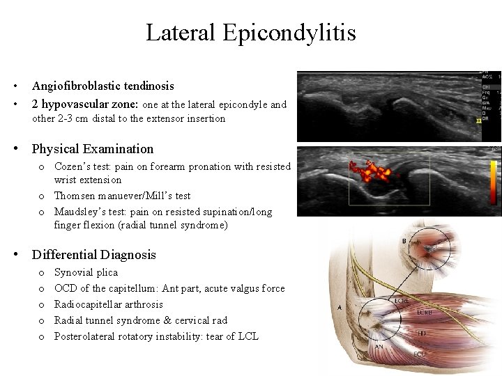 Lateral Epicondylitis • • Angiofibroblastic tendinosis 2 hypovascular zone: one at the lateral epicondyle