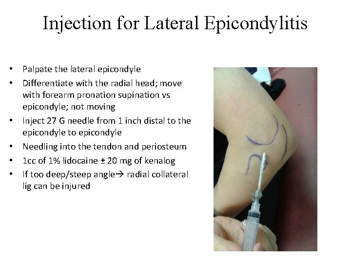 Injection for Lateral Epicondylitis • Palpate the lateral epicondyle • Differentiate with the radial