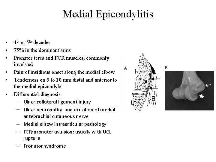 Medial Epicondylitis • • • 4 th or 5 th decades 75% in the