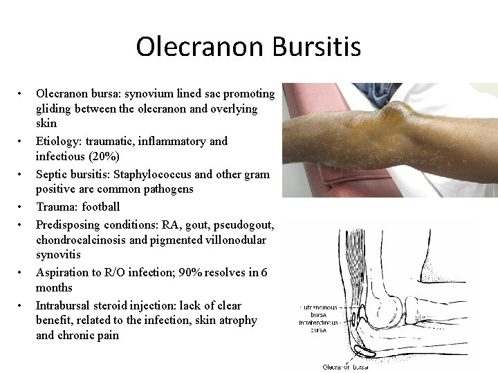 Olecranon Bursitis • • Olecranon bursa: synovium lined sac promoting gliding between the olecranon