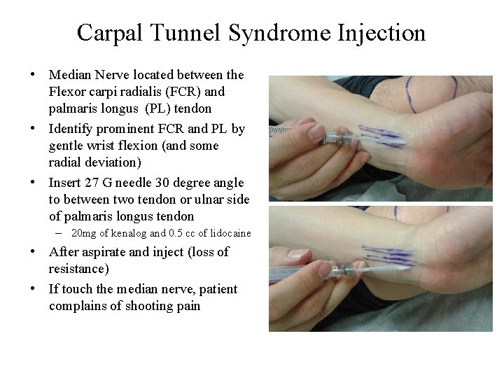 Carpal Tunnel Syndrome Injection • Median Nerve located between the Flexor carpi radialis (FCR)