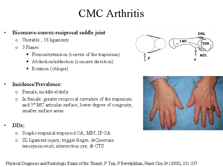 CMC Arthritis • Biconcave-convex-reciprocal saddle joint o Unstable , 16 ligaments o 3 Planes