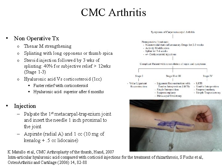CMC Arthritis • Non Operative Tx o Thenar M strengthening o Splinting with long
