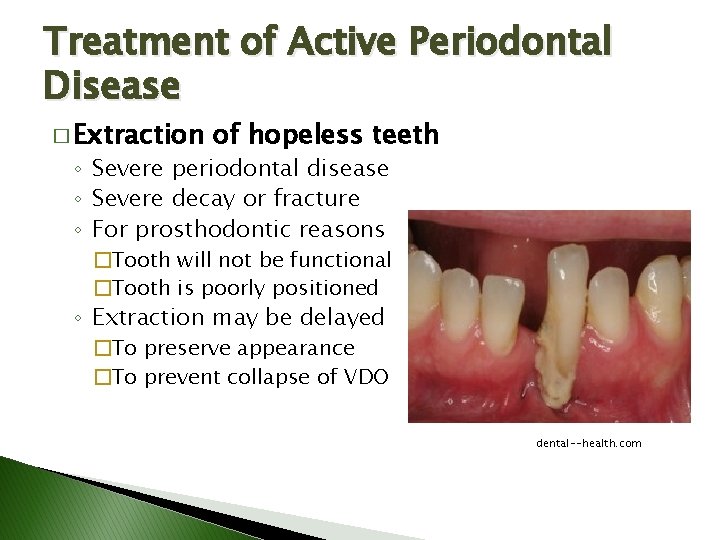Treatment of Active Periodontal Disease � Extraction of hopeless teeth ◦ Severe periodontal disease Treatment of Active Periodontal Disease � Extraction of hopeless teeth ◦ Severe periodontal disease