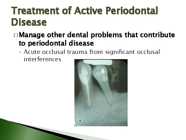 Treatment of Active Periodontal Disease � Manage other dental problems that contribute to periodontal Treatment of Active Periodontal Disease � Manage other dental problems that contribute to periodontal