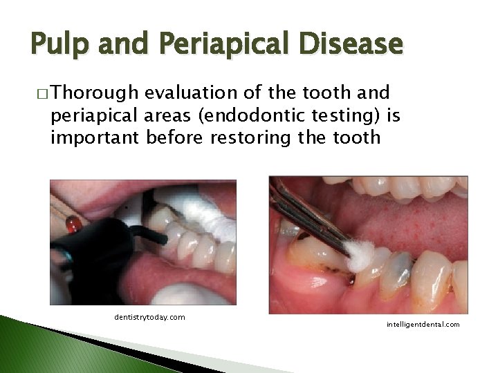 Pulp and Periapical Disease � Thorough evaluation of the tooth and periapical areas (endodontic Pulp and Periapical Disease � Thorough evaluation of the tooth and periapical areas (endodontic
