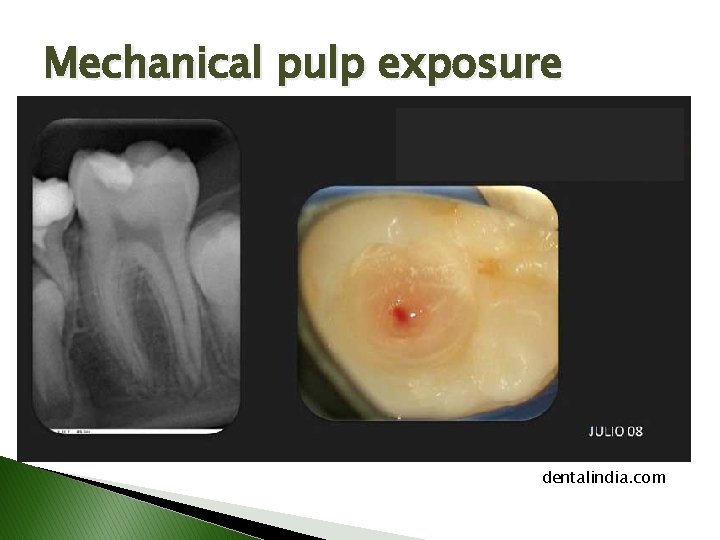 Mechanical pulp exposure dentalindia. com Mechanical pulp exposure dentalindia. com