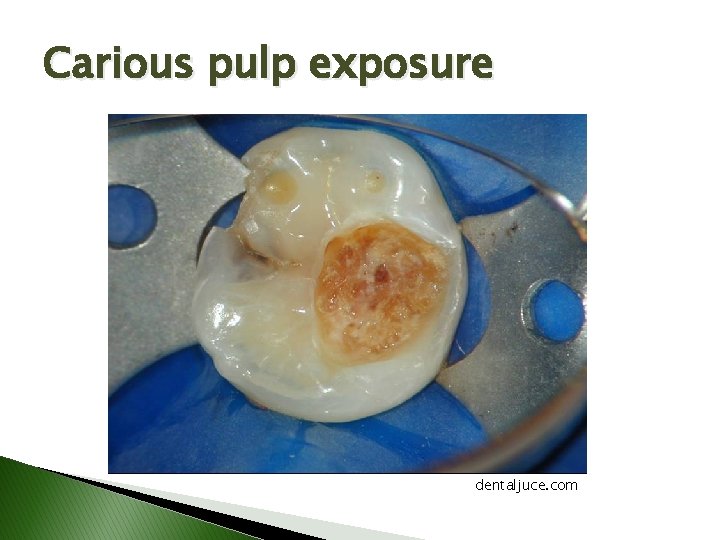 Carious pulp exposure dentaljuce. com Carious pulp exposure dentaljuce. com