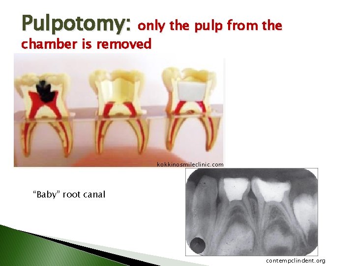 Pulpotomy: only the pulp from the chamber is removed kokkinosmileclinic. com “Baby” root canal Pulpotomy: only the pulp from the chamber is removed kokkinosmileclinic. com “Baby” root canal