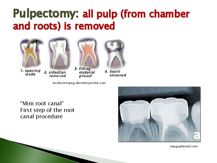 Pulpectomy: all pulp (from chamber and roots) is removed smilewinnipeg. dentistryonline. com “Mini root Pulpectomy: all pulp (from chamber and roots) is removed smilewinnipeg. dentistryonline. com “Mini root
