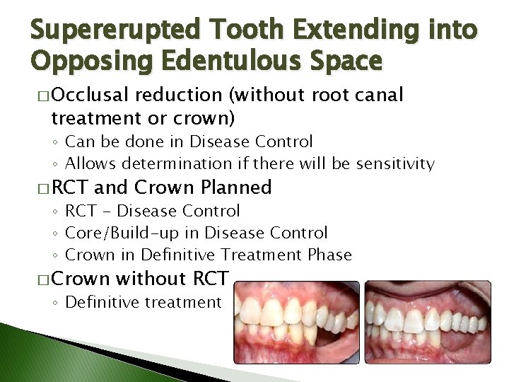Supererupted Tooth Extending into Opposing Edentulous Space � Occlusal reduction (without root canal treatment Supererupted Tooth Extending into Opposing Edentulous Space � Occlusal reduction (without root canal treatment