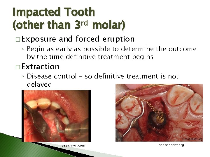 Impacted Tooth (other than 3 rd molar) � Exposure and forced eruption ◦ Begin Impacted Tooth (other than 3 rd molar) � Exposure and forced eruption ◦ Begin