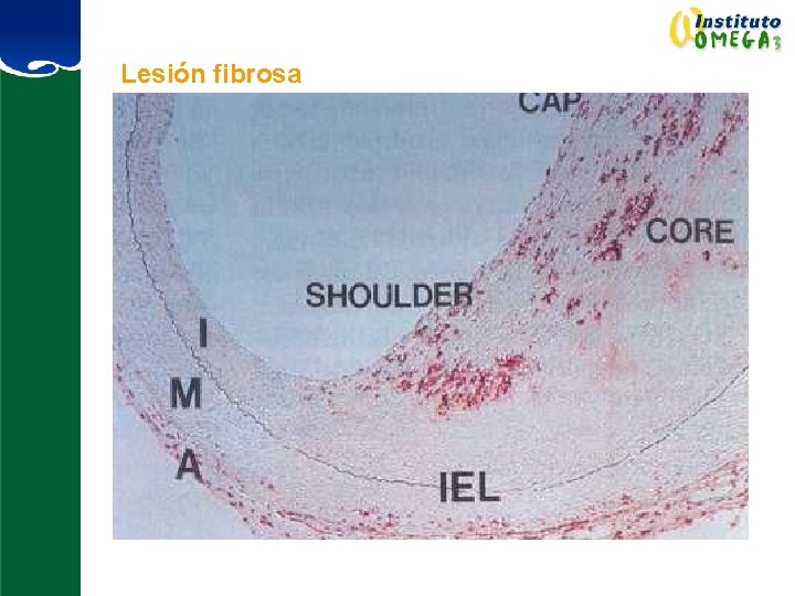 Lesión fibrosa 