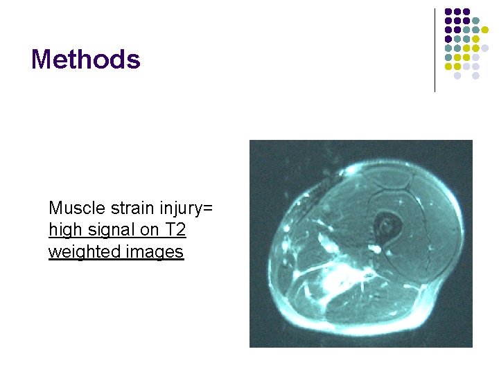 Methods Muscle strain injury= high signal on T 2 weighted images 