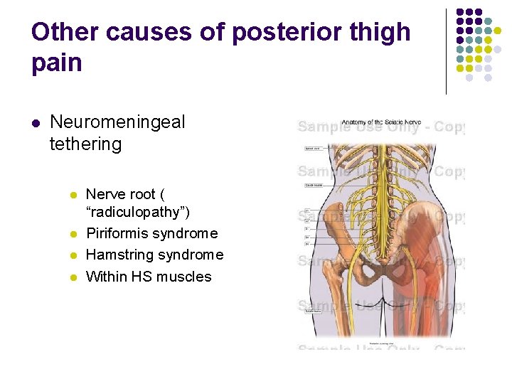 Other causes of posterior thigh pain l Neuromeningeal tethering l l Nerve root (