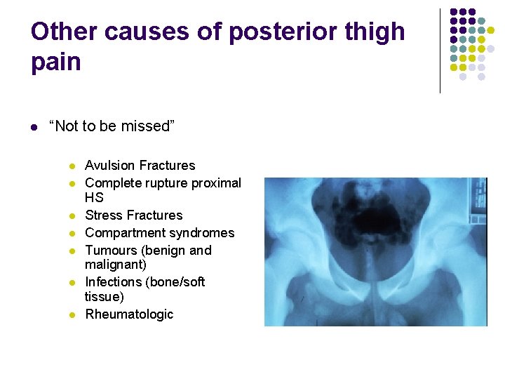 Other causes of posterior thigh pain l “Not to be missed” l l l