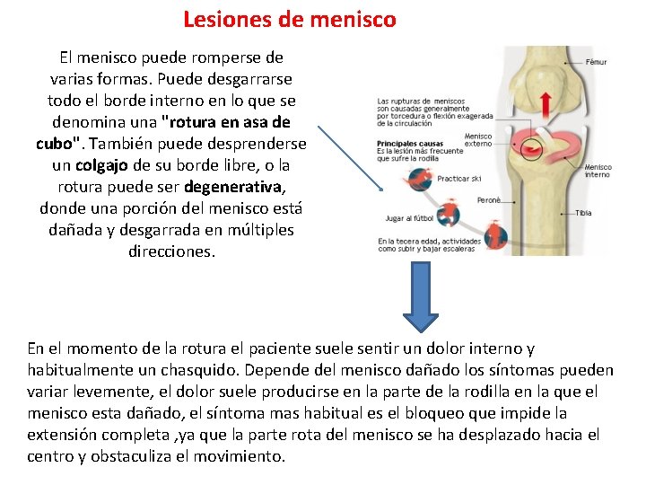 Lesiones de menisco El menisco puede romperse de varias formas. Puede desgarrarse todo el Lesiones de menisco El menisco puede romperse de varias formas. Puede desgarrarse todo el