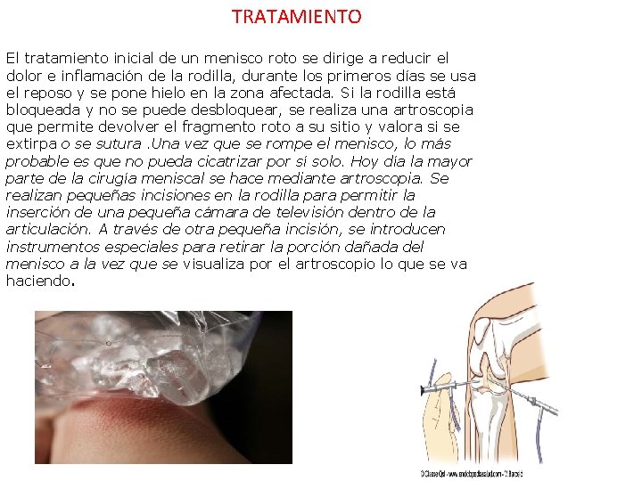 TRATAMIENTO El tratamiento inicial de un menisco roto se dirige a reducir el dolor TRATAMIENTO El tratamiento inicial de un menisco roto se dirige a reducir el dolor