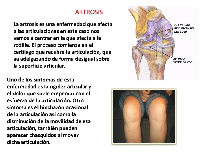 ARTROSIS La artrosis es una enfermedad que afecta a las articulaciones en este caso