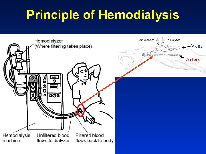 Principle of Hemodialysis Vein Artery 