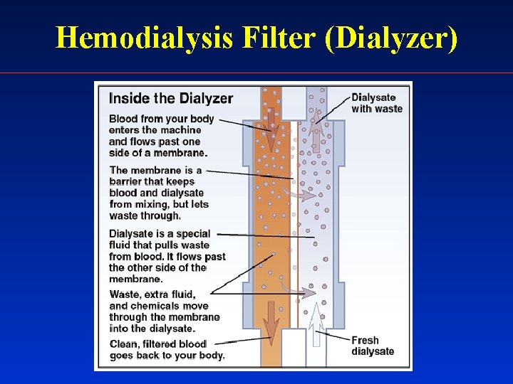 Hemodialysis Filter (Dialyzer) 