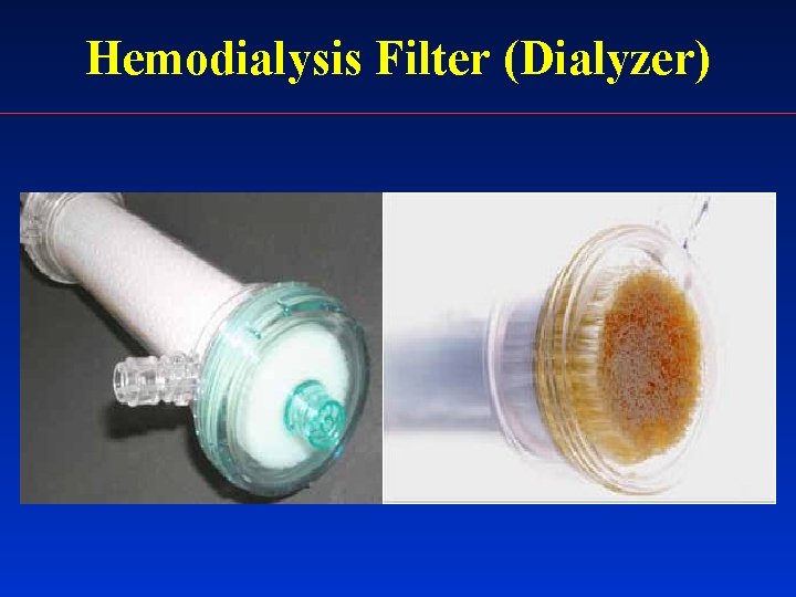 Hemodialysis Filter (Dialyzer) 
