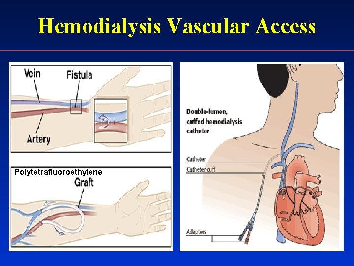 Hemodialysis Vascular Access Polytetrafluoroethylene 