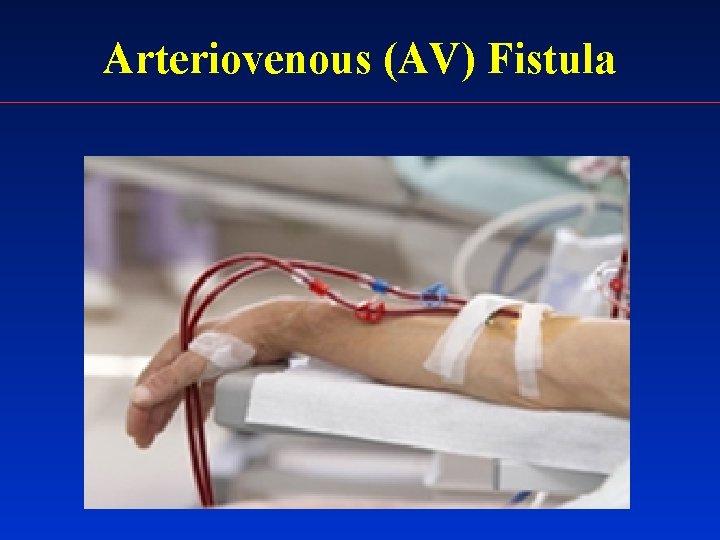 Arteriovenous (AV) Fistula 