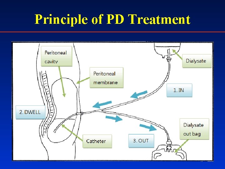 Principle of PD Treatment 
