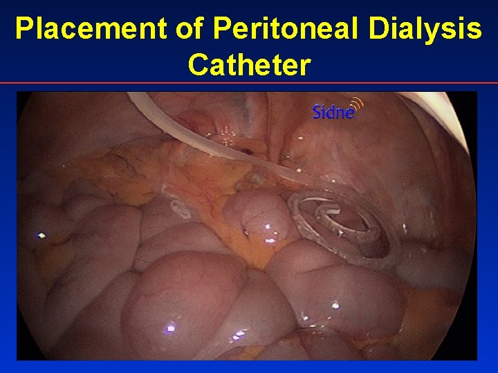 Placement of Peritoneal Dialysis Catheter 