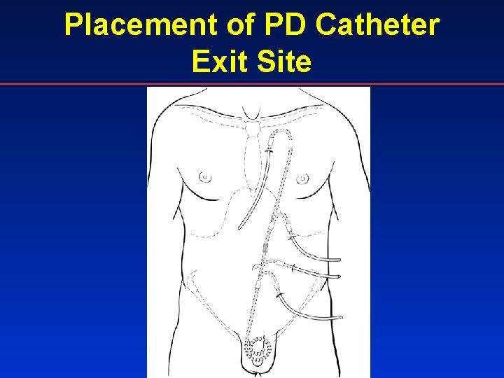 Placement of PD Catheter Exit Site 