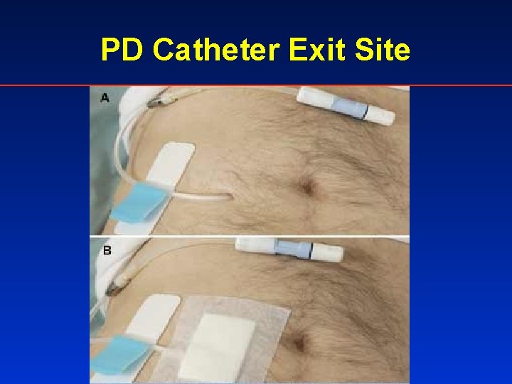 PD Catheter Exit Site 