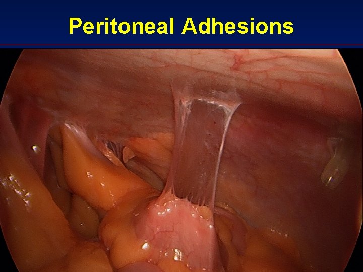 Peritoneal Adhesions 