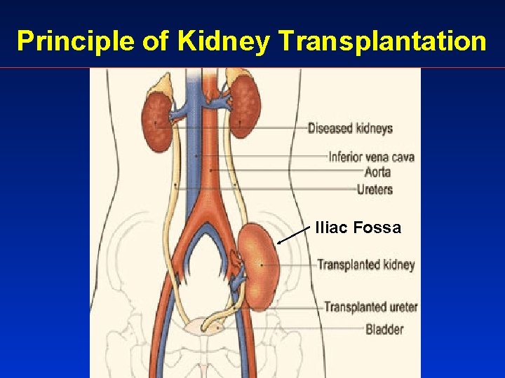 Principle of Kidney Transplantation Iliac Fossa 