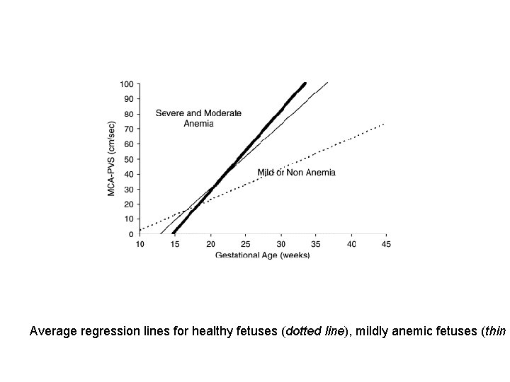 Average regression lines for healthy fetuses (dotted line), mildly anemic fetuses (thin l 