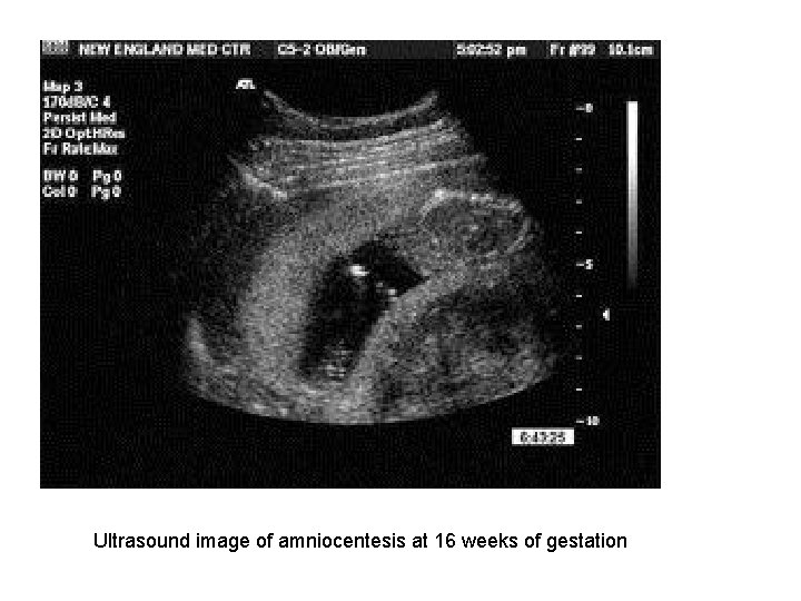Ultrasound image of amniocentesis at 16 weeks of gestation 
