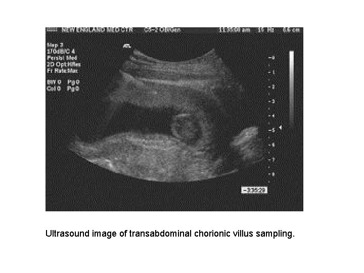 Ultrasound image of transabdominal chorionic villus sampling. 