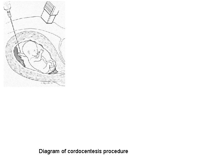 Diagram of cordocentesis procedure 