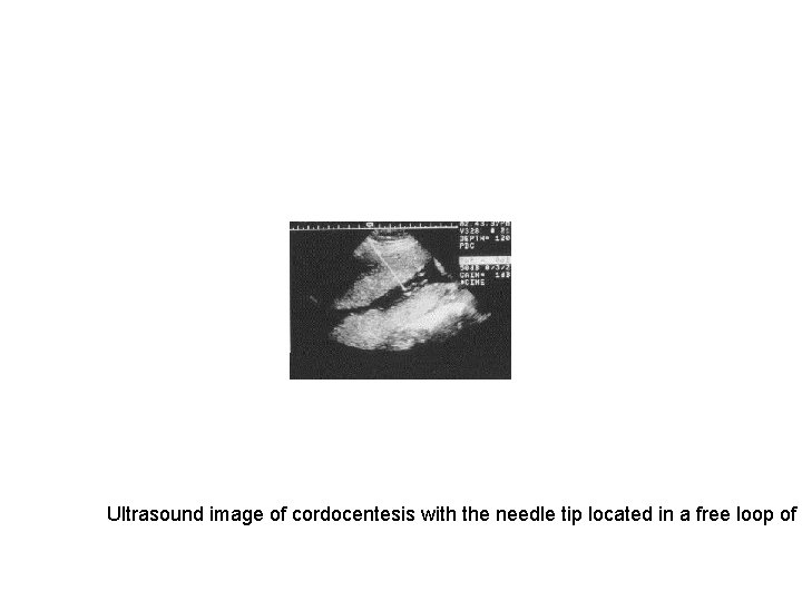 Ultrasound image of cordocentesis with the needle tip located in a free loop of