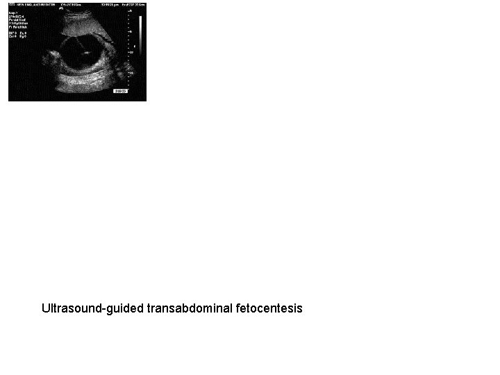 Ultrasound-guided transabdominal fetocentesis 