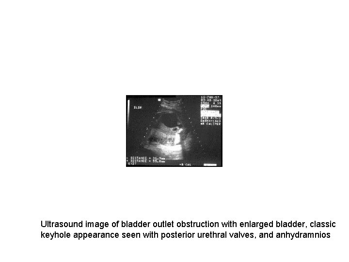 Ultrasound image of bladder outlet obstruction with enlarged bladder, classic keyhole appearance seen with
