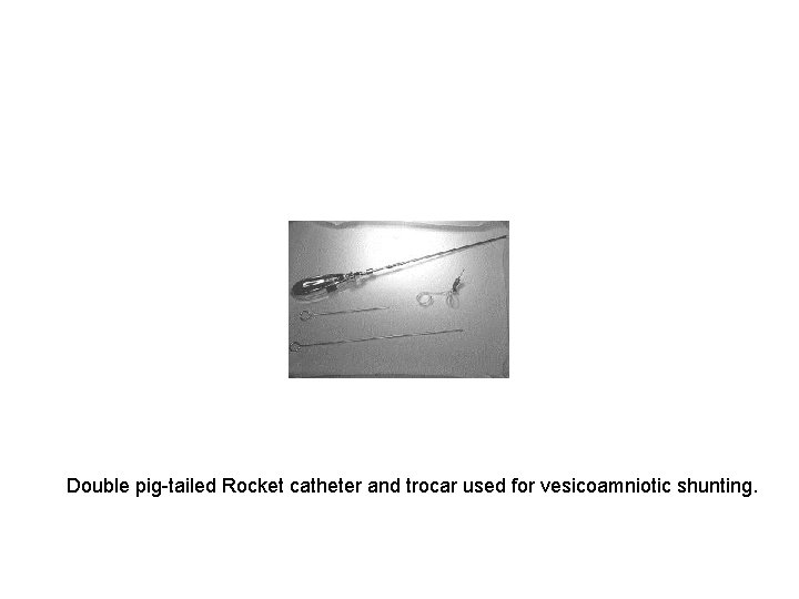 Double pig-tailed Rocket catheter and trocar used for vesicoamniotic shunting. 