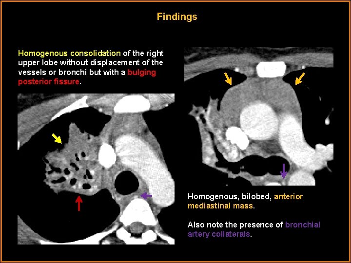 Findings Homogenous consolidation of the right upper lobe without displacement of the vessels or