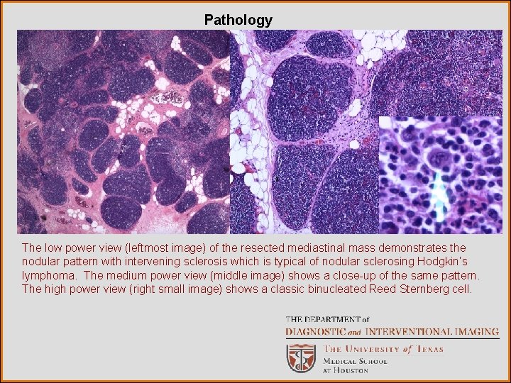 Pathology The low power view (leftmost image) of the resected mediastinal mass demonstrates the