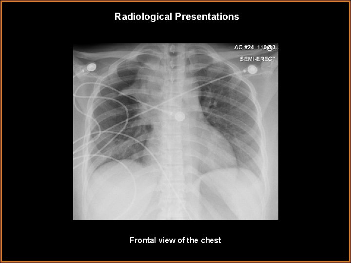 Radiological Presentations Frontal view of the chest 