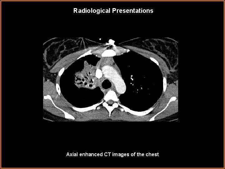 Radiological Presentations Axial enhanced CT images of the chest 